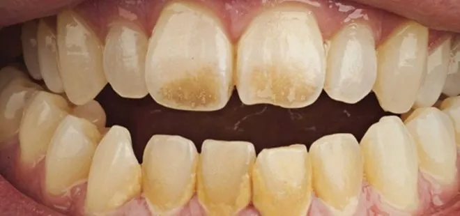 Diş nasıl beyazlatılır? Sararan dişleri bembeyaz yapan yöntemler...