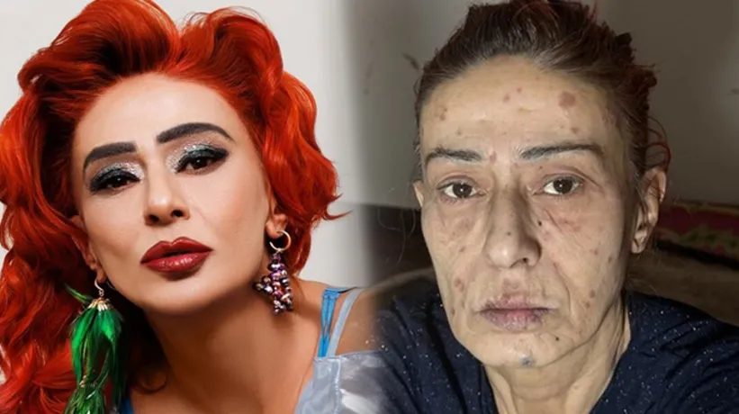 Saç boyası Yıldız Tilbe'nin yüzünü yakmıştı! Uzmanlardan uyarı geldi