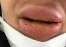 Botoks felaketi son anda engellendi!