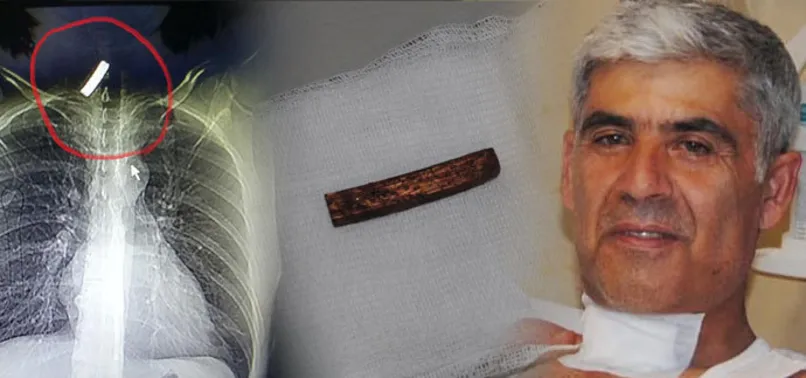 Pes!.. 15 ay sonra boğaz ağrısı şikayetiyle ortaya çıktı!