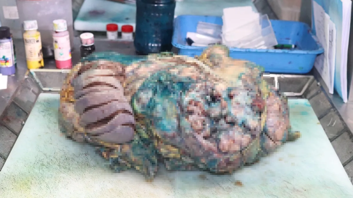 Karın ağrısı ve şişlik şikayetiyle gitti! Karnından çıkan doktorları bile şoke etti