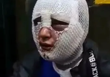 Kız arkadaşının yüzüne kızgın yağ döken eski sevgili tekrar tutuklandı