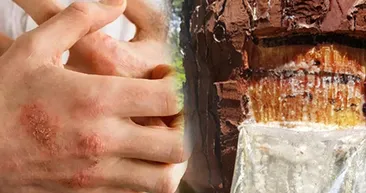 Egzamanın kökünü kurutan doğal ilaç tarifi!