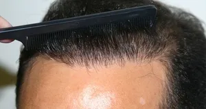 Saç ekiminde uzman tecrübesine dikkat