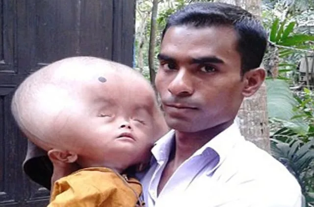 Bangladeşli Emon’un kafası süreli büyüyor