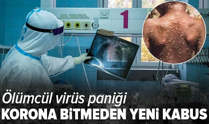 Son dakika: Koronavirüs devam ederken ölümcül maymun çiçeği virüsü kabusu!