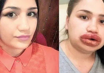 Silikon faciası! Dudakları alınabilir!