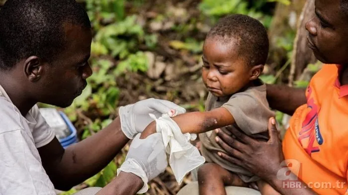 Maymun çiçek virüsü yeni salgına davetiye çıkardı! Avrupa’da vaka sayısı artışta, tedavisi yok 11