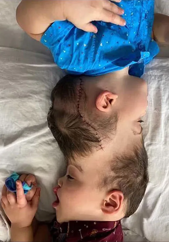 Tarihe geçen ameliyat: Yapışık ikizleri sanal gerçeklik ayırdı