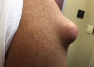 Kolundaki şişliği sivilce zannetti ama gerçek dehşete düşürdü! Bakın içinden ne çıktı