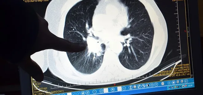 Uzmanı açıkladı: Akciğer kanseri bu yaşlarda daha sık görülüyor!