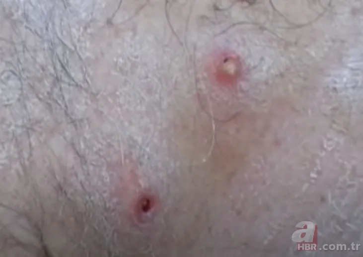 Sırtındaki yarayı sivilce zannetti ama gerçek dehşete düşürdü! Bakın içinden ne çıktı 17