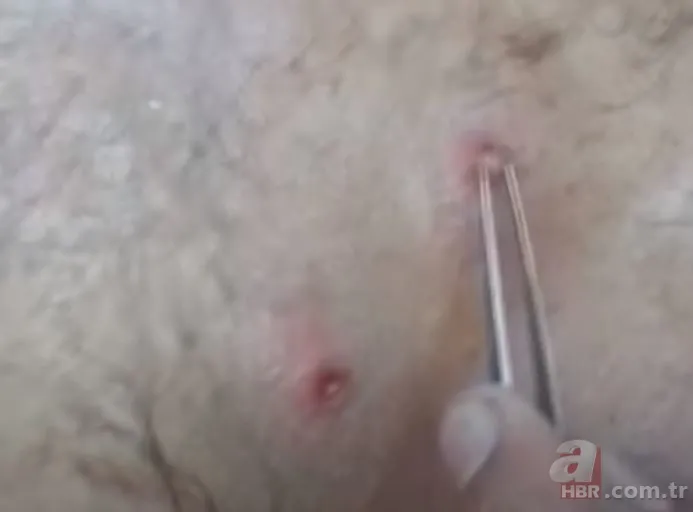 Sırtındaki yarayı sivilce zannetti ama gerçek dehşete düşürdü! Bakın içinden ne çıktı 22