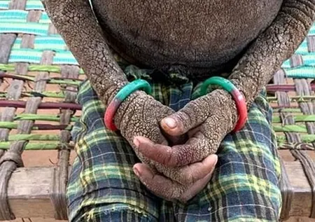 Vücudu her geçen gün taşa dönüşüyor!