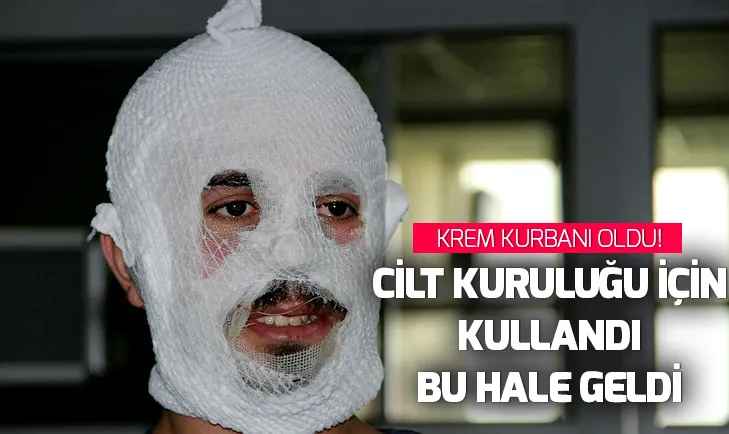 Cilt kuruluğu için kullandığı krem bu hale getirdi
