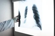 Akciğer kanserinde erken teşhis hayat kurtarıyor