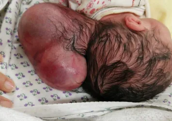 Hatay'da iki kafalı bebek dünyaya geldi