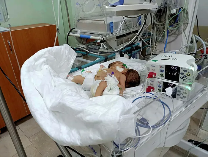 Afrinli yapışık ikizler Hatay’a getirildi - 2