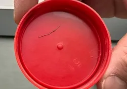 Bebeğin sırtından tel parçası çıktı