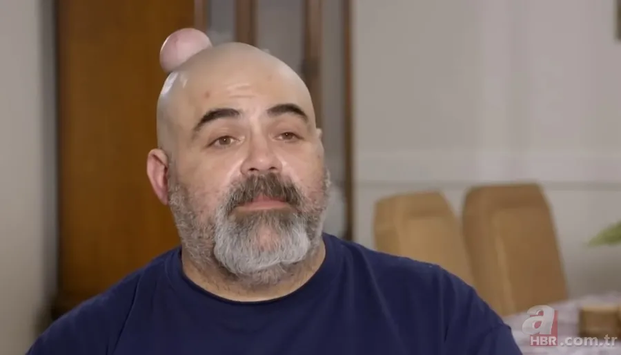 Sokağa şapka ile çıkıyordu! Başındaki şişlikten bakın ne çıktı 👩⚕️ Görenleri şaşkına çeviren olay 11