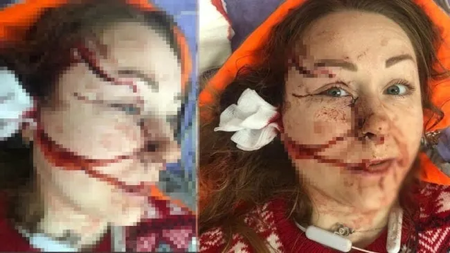 Boşanmak istediği için kocasının yüzünü falçatayla parçalandığı Ukraynalı Hanna yeni bir hayat kurdu - 3