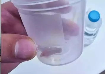 1,5 yıllık öksürüğün nedeni kabak çekirdeği çıktı