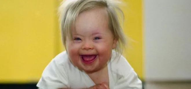 Down Sendromu nedir ve nasıl anlaşılır?