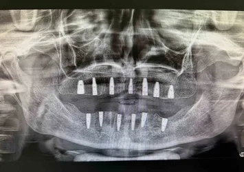 Tamamen dişsiz hastanın implantla hayatı değişti