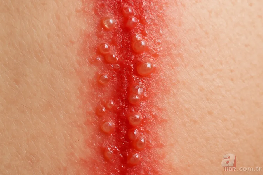 Kobra zehrinden güçlü! Bu böceği sakın ezmeyin, dokunduğunda tehlike saçıyor 4