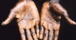 DSÖ’den çarpıcı ’M çiçeği virüsü’ açıklaması