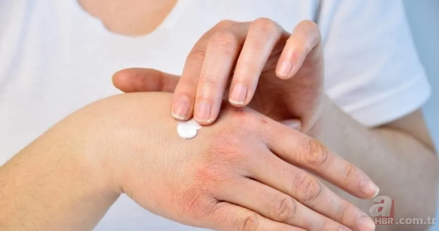 Kuruluğa, kızarıklığa ve acıya son! Eldeki kaşıntı ve egzamayı rahatlatacak yöntem! Tek damlasını sürünce... 4