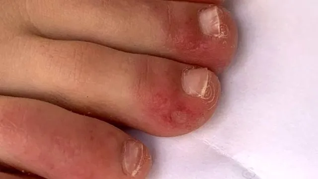 İspanya'da koronavirüsle bağlantılı görünen 5 farklı deri sorunu tespit etti - 1