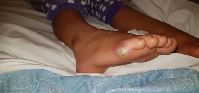 İngiltere’de 4 yaşındaki çocuk denediği ayakkabıdan bakteri kaptı