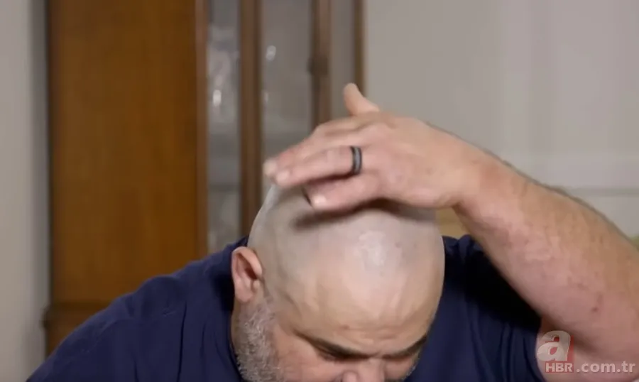 Sokağa şapka ile çıkıyordu! Başındaki şişlikten bakın ne çıktı 👩⚕️ Görenleri şaşkına çeviren olay 6