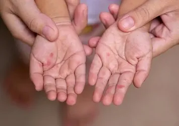 Uzmanı uyardı: 'Okullarda hızla yayılıyor' Çocuklarda bu belirtiler varsa...