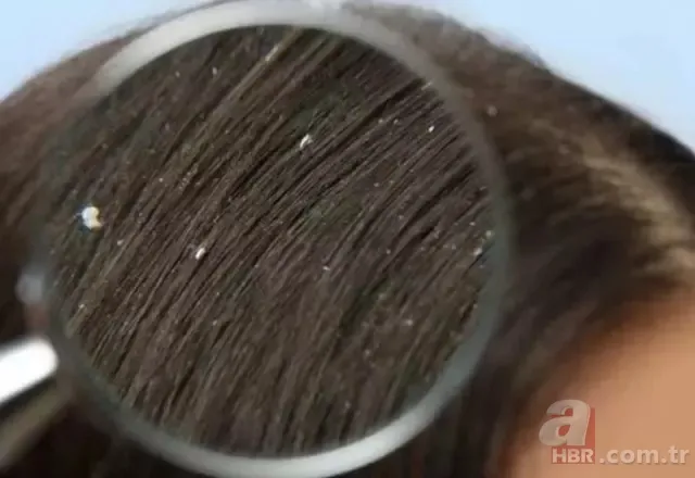 1 damlası bile yetiyor! Şampuanın içine bunu ekleyin! Saç derinizi tertemiz yapacak! Egzama, kaşıntı, kepek... 6