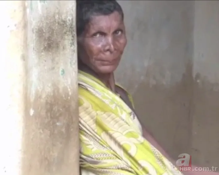 Hindistan’da Polidaktili hastası kadın cadı denilerek dışlandı