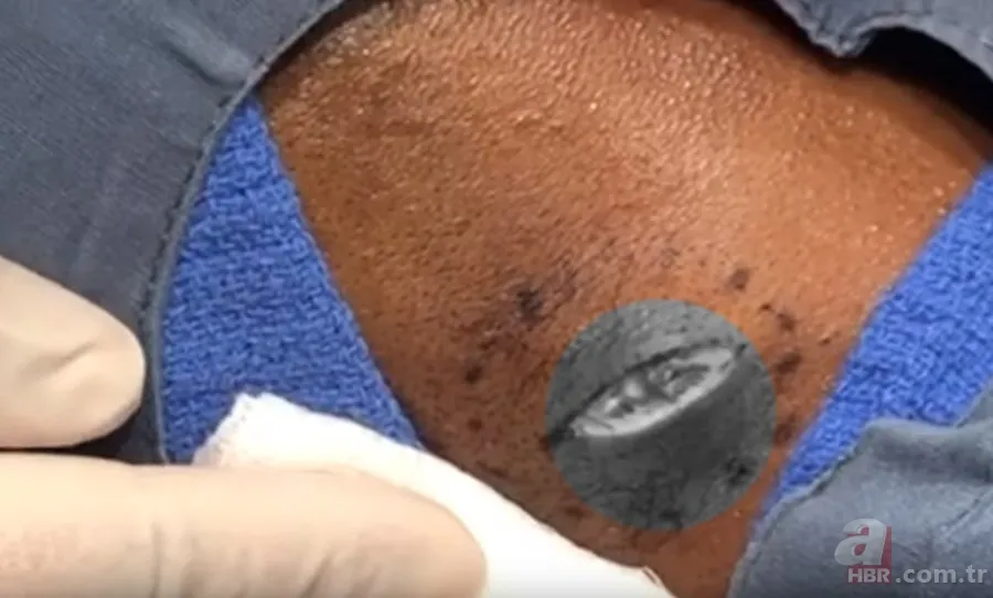 Kolundaki sivilceden böcek çıktı 👩⚕️ Doktora gidince şoke oldu | Cımbızla çektikçe içi gitti 15