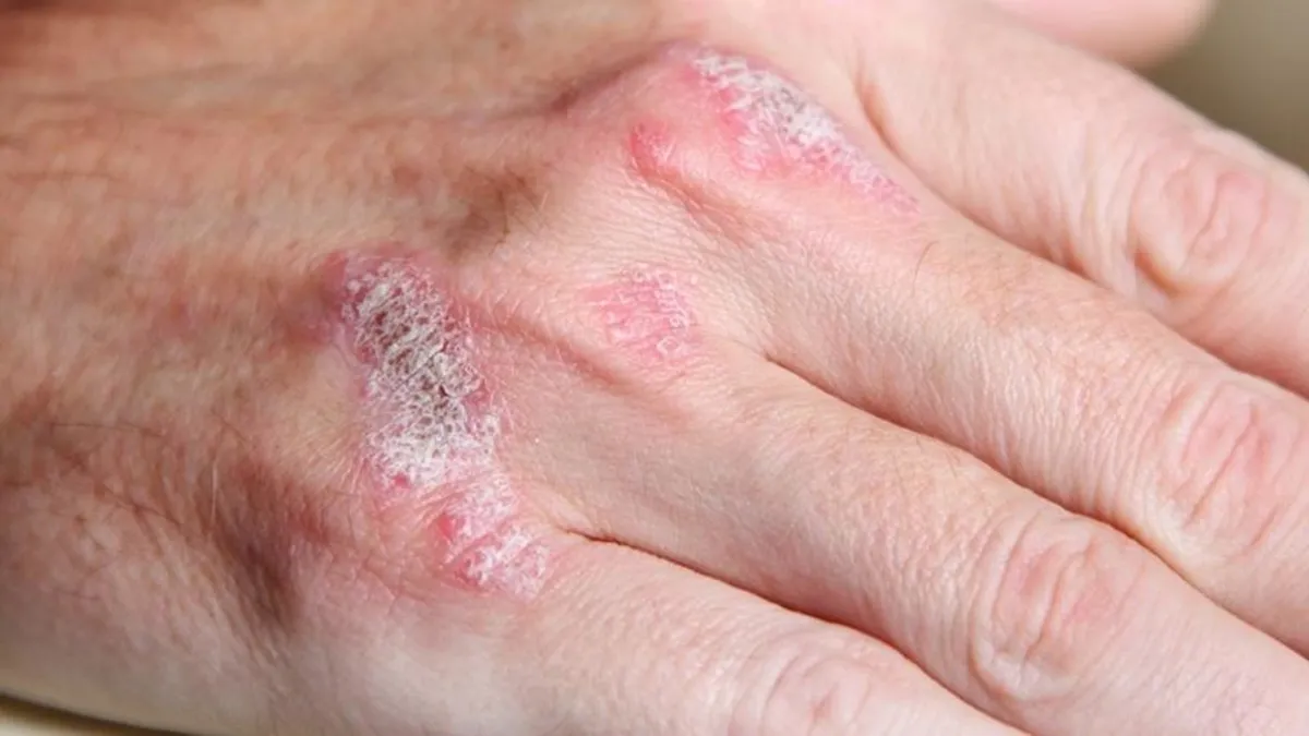 Kuru ciltliler dikkat! Vitamin eksikliği yaşıyor olabilirsiniz...