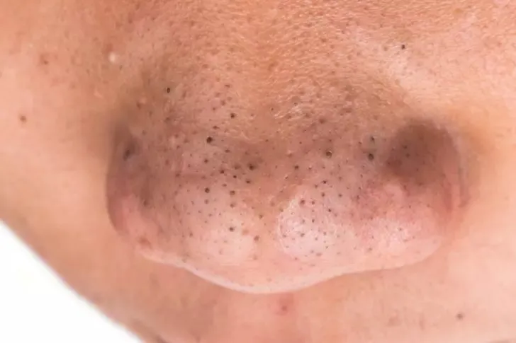 Siyah noktaları yok eden maske tarifi: Bu 2 malzeme vakum gibi çekiyor...
