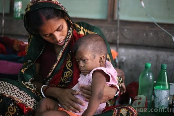 Dünyanın en tuhaf hastalıkları 11