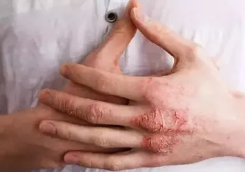 Egzamayı tetikliyor! Sakın bu hataları yapmayın...