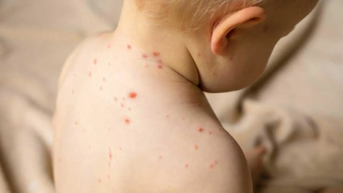 2023'te dünya genelinde 10,3 milyon kızamık vakası görüldü