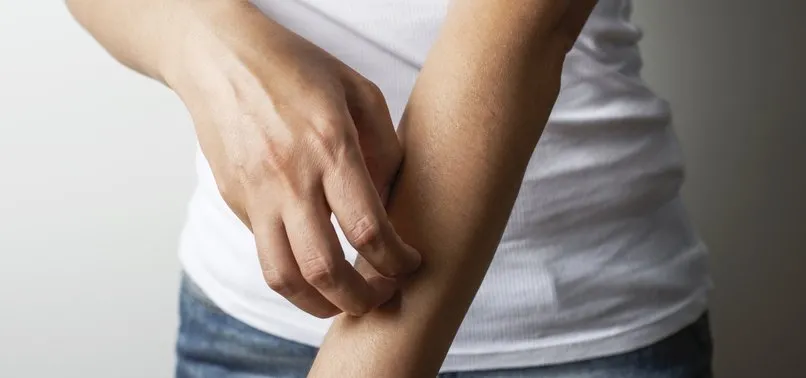 uyuz belirtileri nelerdir