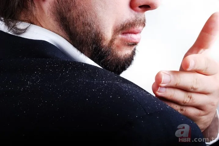 Kepek kabusuna "doğal" çözüm! 9