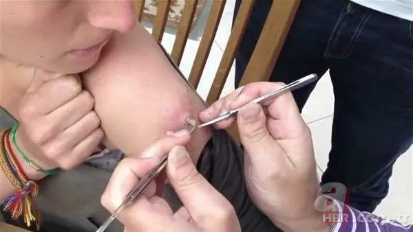 Genç kadının kolundan çıkanlar şoke etti 20