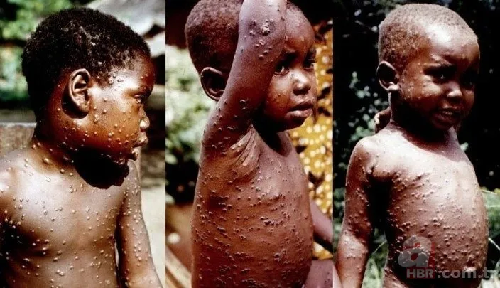 Maymun çiçeği Türkiye'de görüldü mü? Bakan Fahrettin Koca duyurdu! Maymun çiçeği virüsü belirtileri neler, nasıl bulaşır? 6