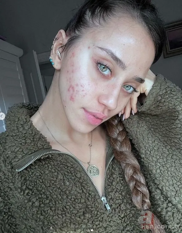 Hamdi Alkan’ın kızı Zeynep Alkan bir makyajlı bir de sivilceli yüzünü paylaştı! 2 kare arasındaki fark şoke etti 25