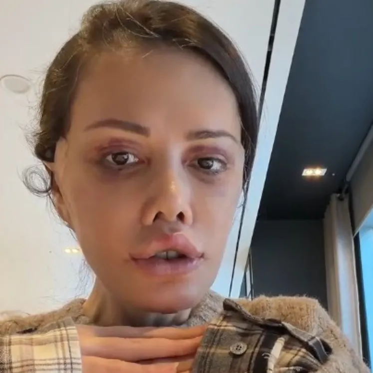 Yüz nakli olan Didem Ceran kansere yakalandı