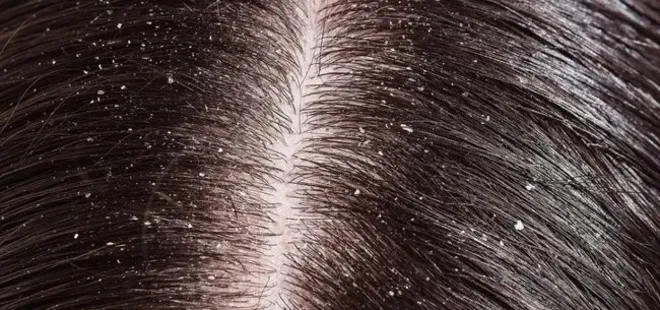 İbn-i Sina’dan asırlık tavsiye! Saçtaki kepeği yok ediyor...